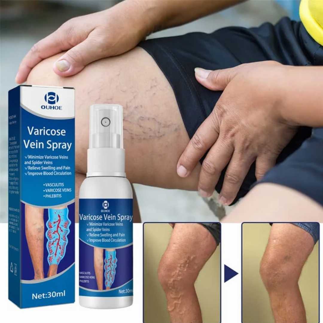 Varicose Vein Treatment Spray